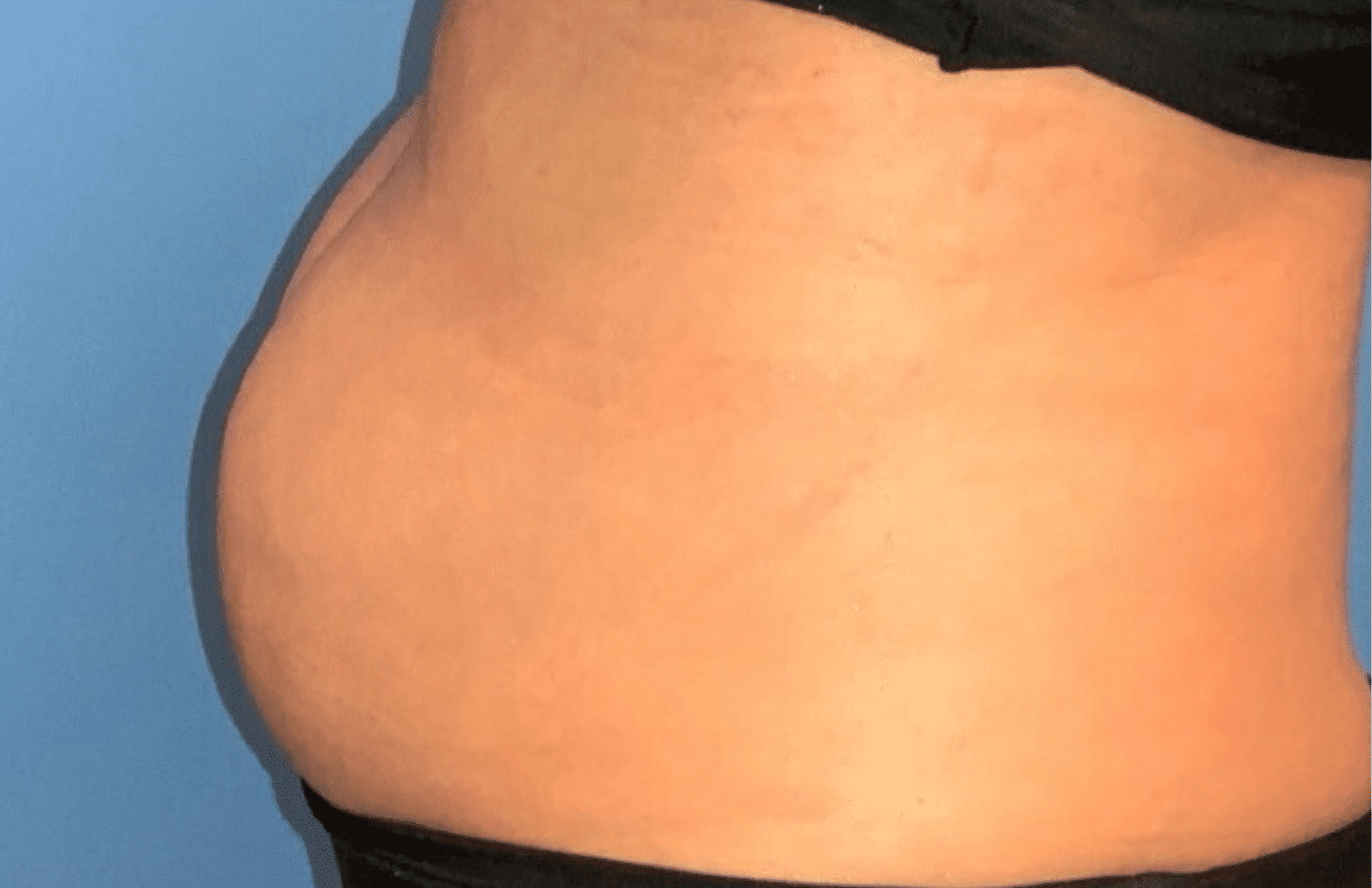 Before Image: CoolSculpting Elite - front