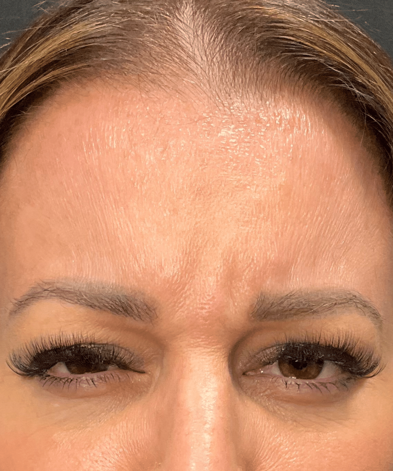 Before Image: Botox - front