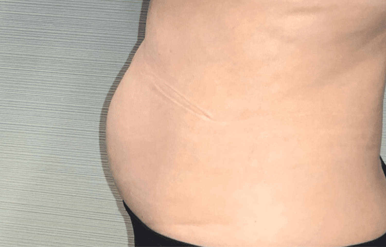 After Image: CoolSculpting Elite - front