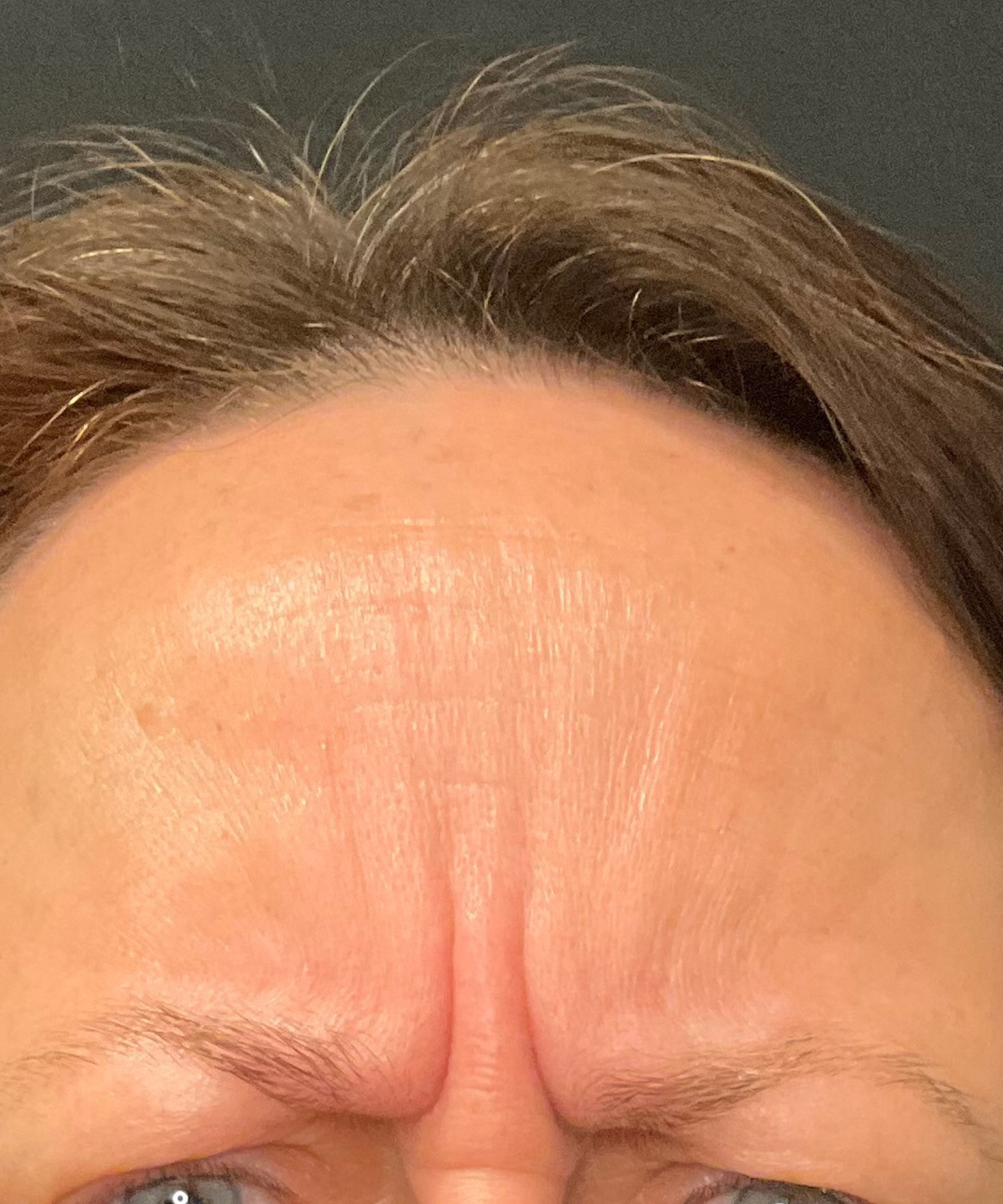Before Image: Botox - front