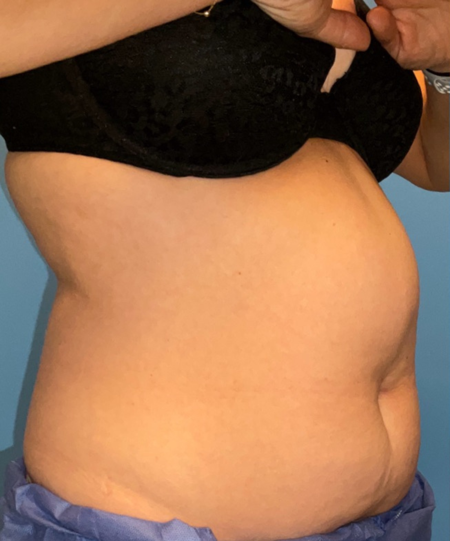 Before Image: CoolSculpting Elite - right-front-oblique