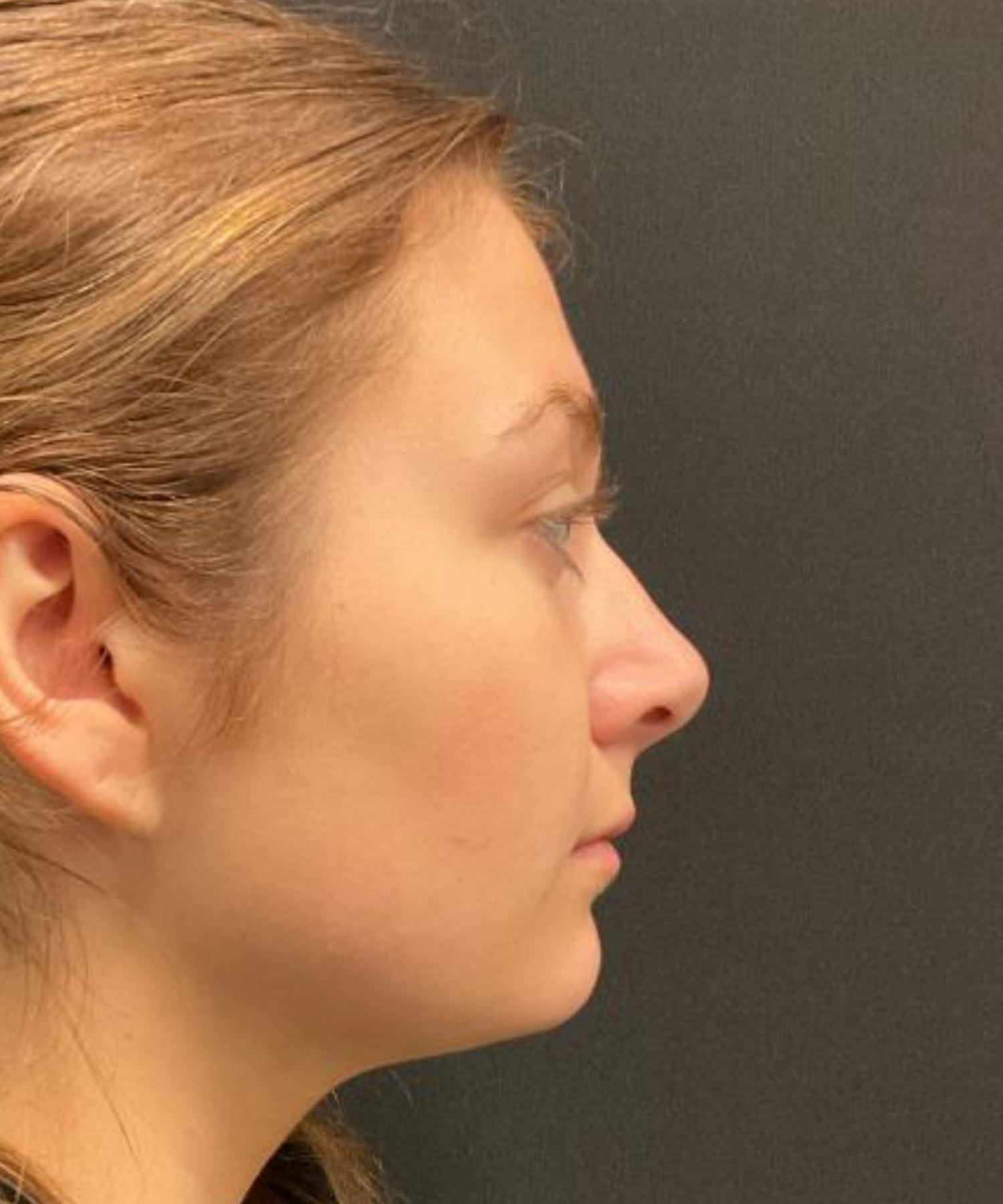 Before Image: Lip Filler with Botox Lip Flip - 