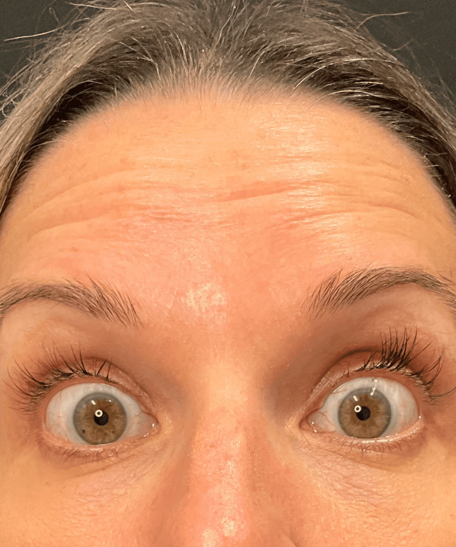 5 Before Botox Cosmetic in Hauppauge, NY