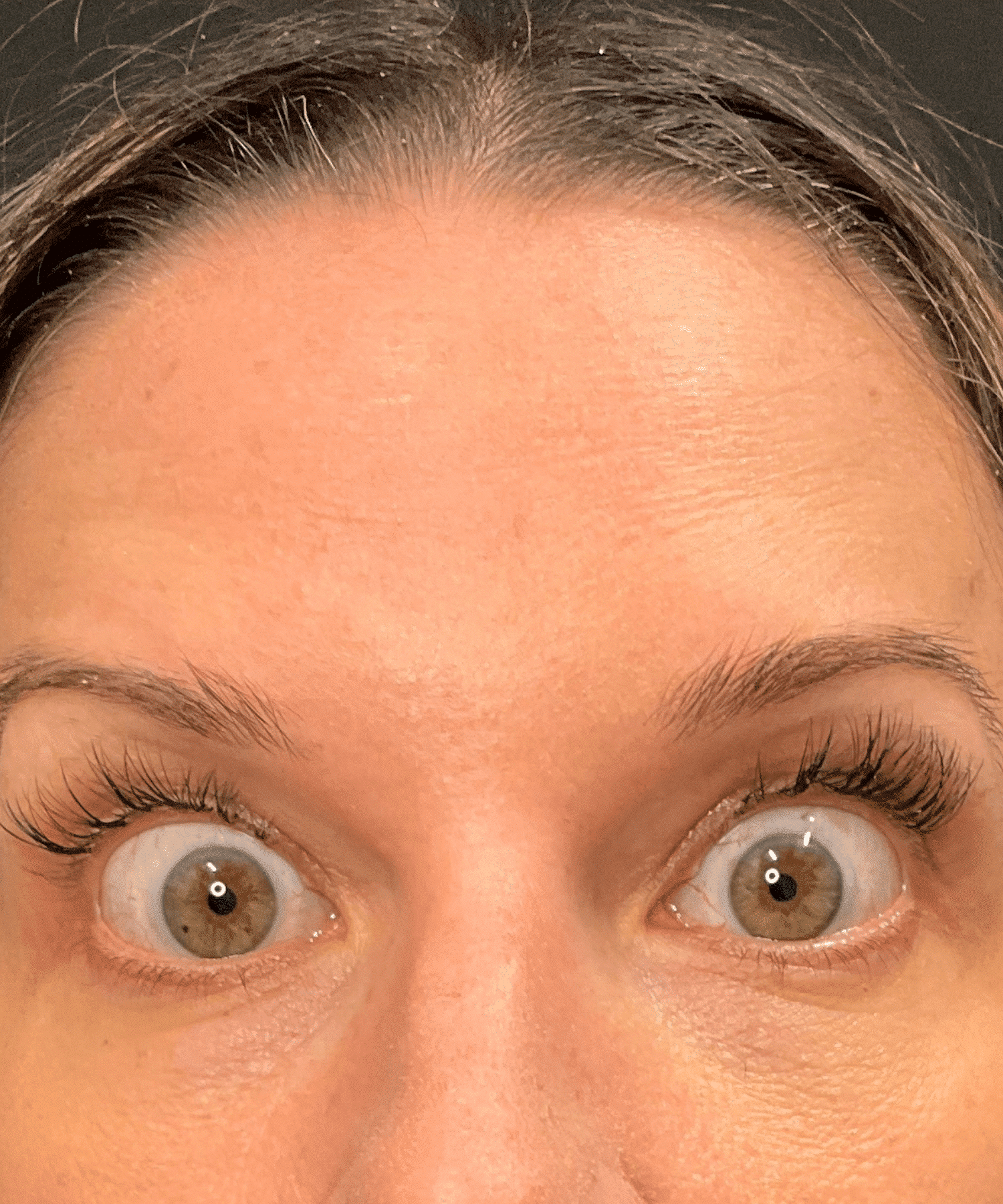 6 After Botox Cosmetic in Hauppauge, NY