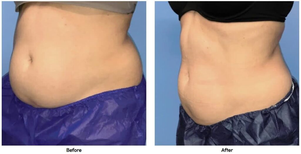 1759875344_coolsculpting-case