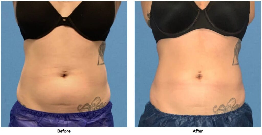 1759875348_coolsculpting-case-2