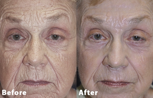 contour trl before after 2 contour trl before after 2