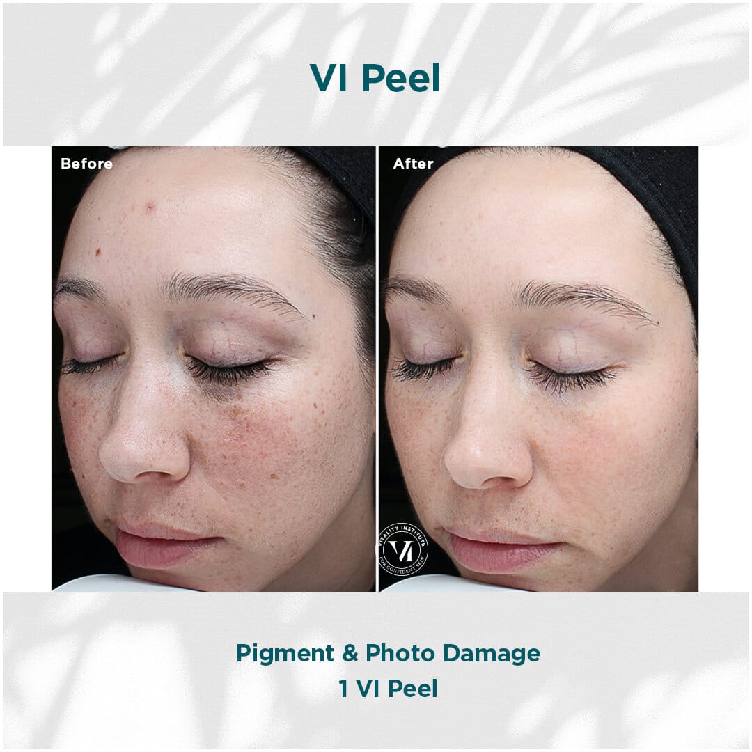 Before & After Photos of Vi Peel Hauppauge NY